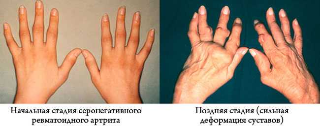 Как предотвратить инсульт?